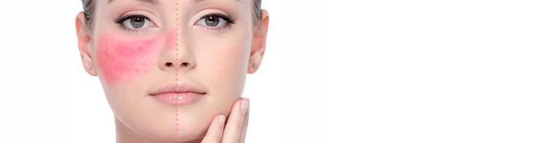  Maquillaje Para Pieles con Rosácea – Beauty Essentials Store